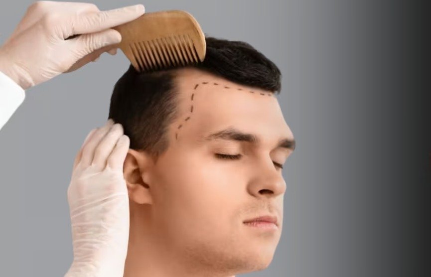 Cara Hair Transplant Clinic